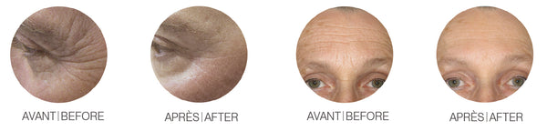 Axis 27.12 MHz Radio Frequency Anti-Aging Technology